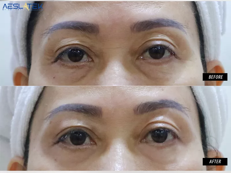 Vùng da mắt lão hóa cải thiện rõ rệt ngay sau liệu trình