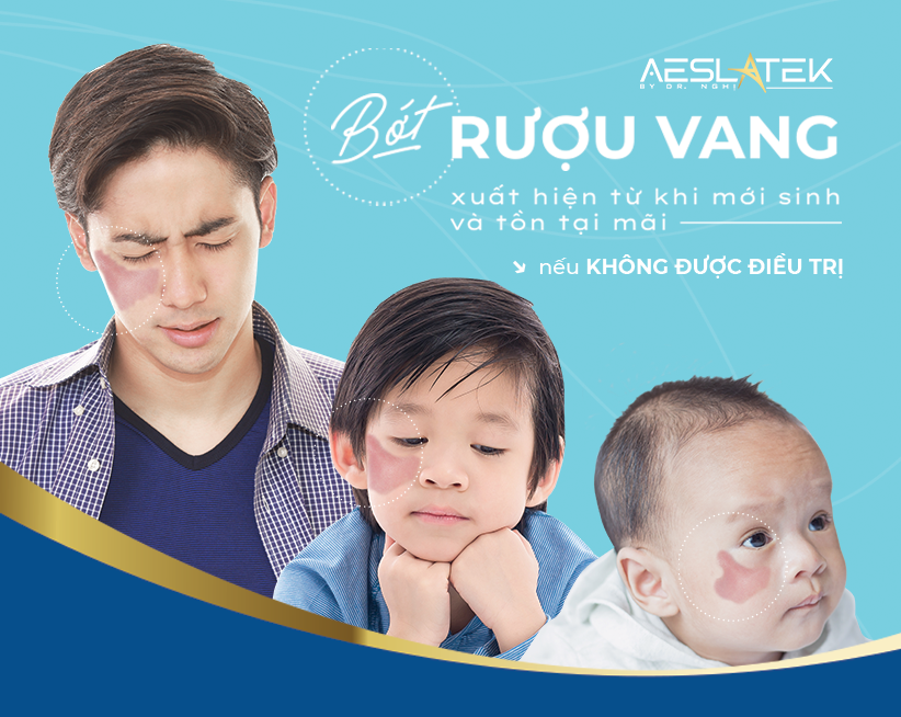 Điều trị dị dạng mao mạch
