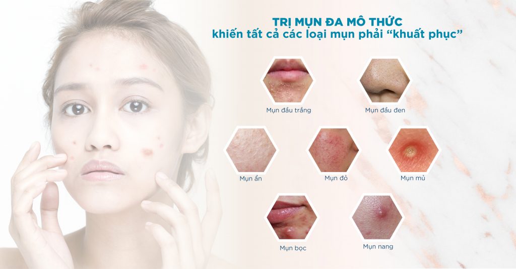 Trị mụn chứng cá đa mô thức